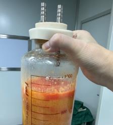 丹阳水动力吸脂手术要做多久？